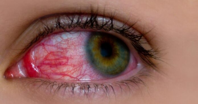 eye आँखा Akha